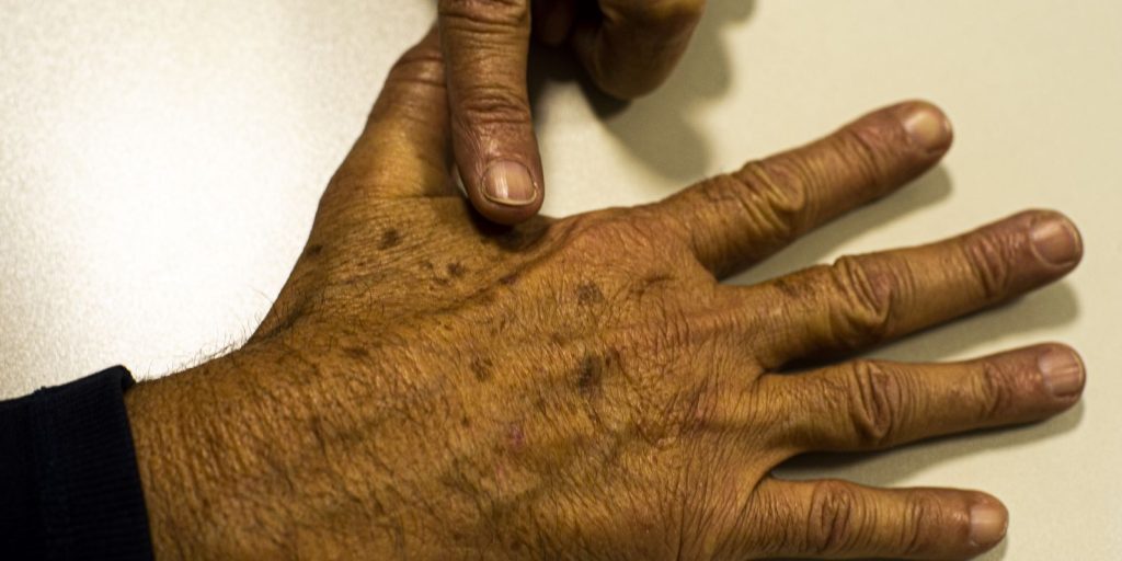 desinformacao-sobre-cancer-de-pele-afeta-diagnostico,-diz-instituicao